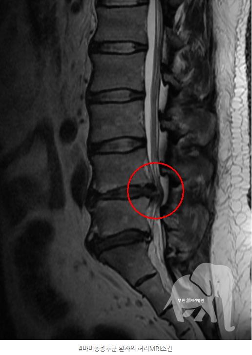 마미총증후군 환자의 허리 MRI소견.[21세기부천병원 제공]